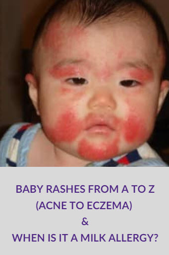 Baby Rashes From A To Z Acne To Eczema And When Is It A Milk Allergy 